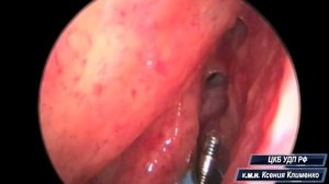 Баллонная синусопластика диссекция