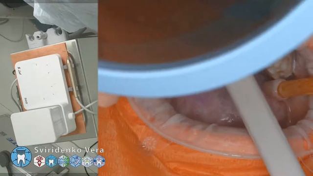 Professional oral hygiene -case 019  Acteon DTE Dentsply Coxo Floweis 3M KerrHawe (FHD multistream)