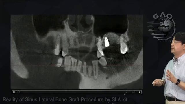 (ENG) Reality of Sinus Lateral Bone Graft Procedure by SLA kit смотреть онлайн