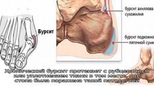 Бурсит стопы
