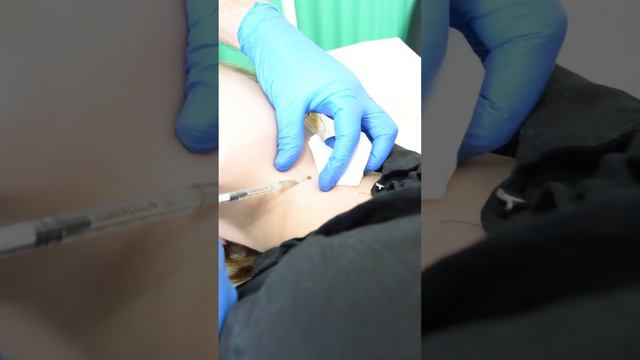 #anesthesia #знеболення#анестезия За мить до видалення родимки смотреть онлайн