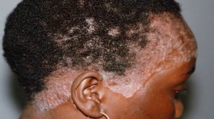 Псориаз кожи головы, симптомы и лечение