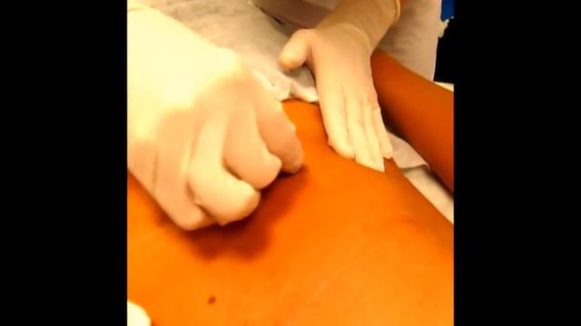 Электролиполиз подкожный смотреть онлайн