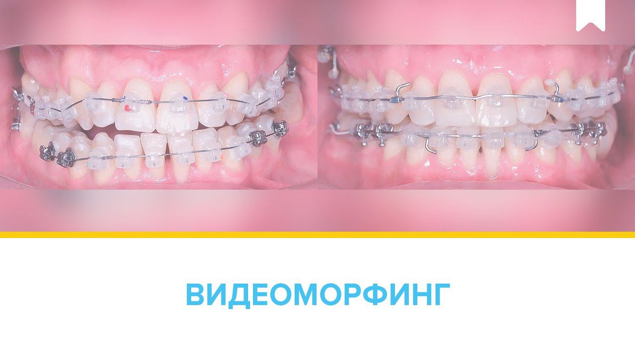 Перелечивание на цифровых брекетах INSIGNIA - прогресс за 2 года.