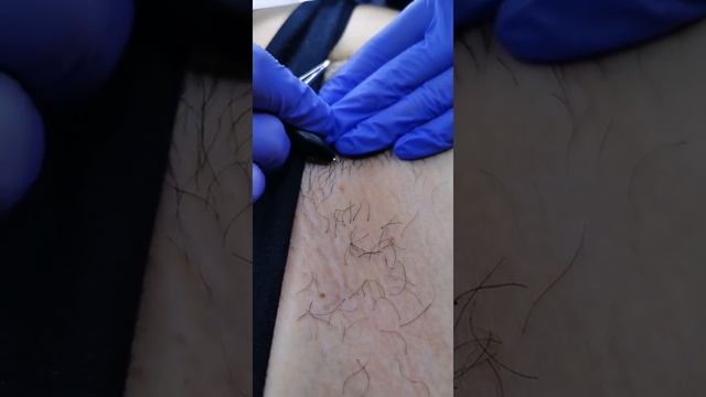 Электроэпиляция обучение смотреть онлайн