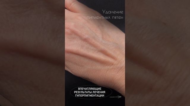 Удалить пигментацию - реально! #пигментация #пигментныепятна