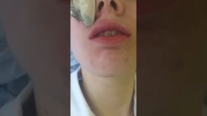 Контурная пластика: увеличение губ