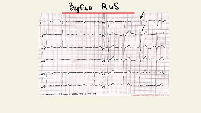 Разбор ЭКГ с неправильно наложенными электродами. Анализ ЭКГ. смотреть онлайн
