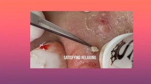 Satisfying Video Blackhead  , Blackhead removal,Успокаивающее расслабление, удаление черных точек