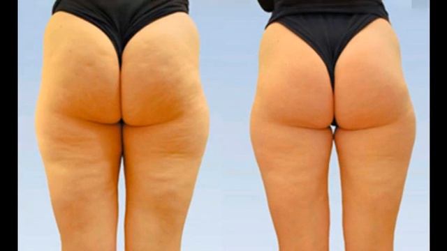 как пользоваться антицеллюлитным кремом смотреть онлайн