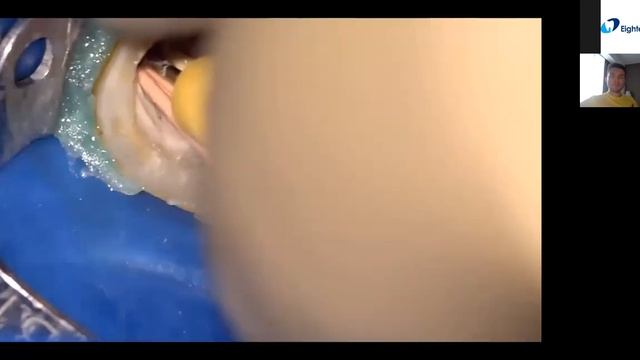 Вебинар на русском языке -  Дмитрий Николаев-  Тема: Трехмерная обтурация системы корневых каналов смотреть онлайн