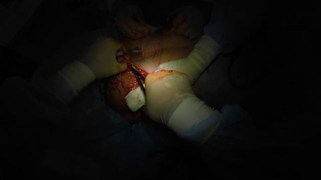 Якорная подтяжка молочной железы с увеличением/Wise pattern & breast augmentation смотреть онлайн