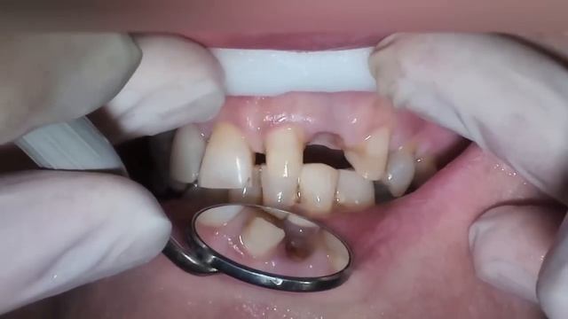 Установка мостовидного зубного протеза, мост смотреть онлайн