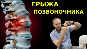 МЕЖПОЗВОНОЧНАЯ ГРЫЖА как лечить без операции. Грыжа позвоночника лечение по методу Смолякова.