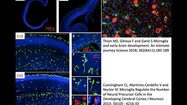 62.  Glioblastoma and astrocytoma IDH-mutant grade 4 GBM tumor microenvironment immunotherapy