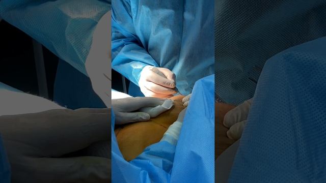 Якорная подтяжка груди без имплантов / Процесс / Пластическая хирургия
