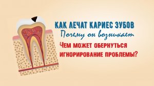Как лечат кариес в стоматологии
