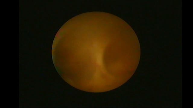 Цистоскопия. Удаление стента правого мочеточника. Уретероскопия справа. смотреть онлайн