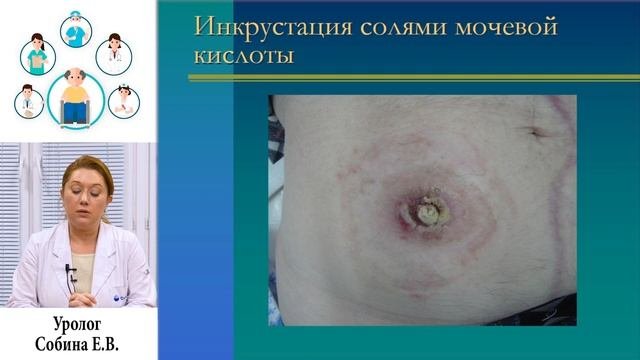 Уростомы - проблемы и решения