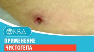 Применение чистотела. Клинический случай №84