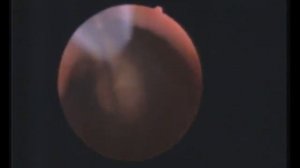 Удалённый полип пролежал в матке 3 месяца. Как он выглядит?