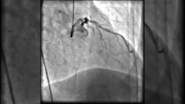 Инфаркт на миокарда видео смотреть онлайн