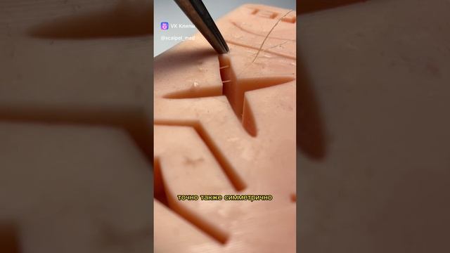 Наложение П-образного шва смотреть онлайн