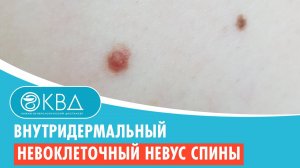 ? Внутридермальный невоклеточный невус спины. Клинический случай №246