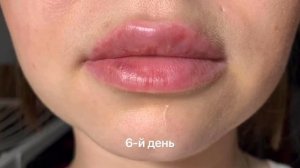 Губы после увеличения. Процесс заживления. Увеличение губ гиалуроновой кислотой