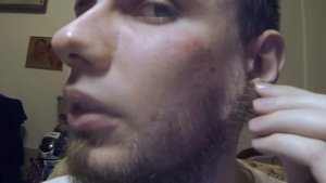 Миноксидил 15%, фиксация результата ДО применения