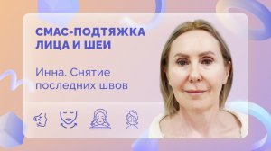 СМАС-подтяжка лица и шеи. Инна. 14 сутки после операции