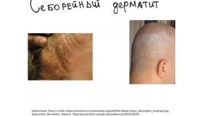Себорея. Себорейный дерматит. Сыпь.