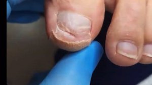 Гиперкератоз😱😨 Установка коррекционной системы🦶🏻