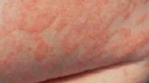 DERMATIT TERI KASALLIGI. ДЕРМАТИТ ТЕРИ КАСАЛЛИГИ.