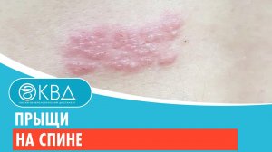 ? Прыщи на спине. Клинический случай №351