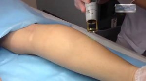 Эпиляция на александритовом лазере Candela