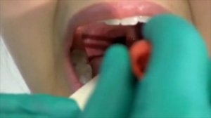 How to perform a throat swab on a patient