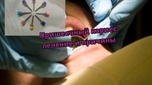 Пришеечный кариес: лечение и причины