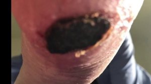 Пётр Гаряев. Диабетическая стопа. Регенерация.