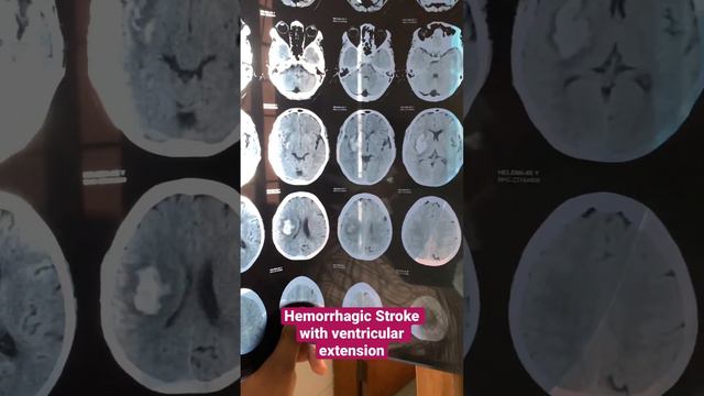 hemorrhagic stroke with ventricular extension #neuroscience #medicine