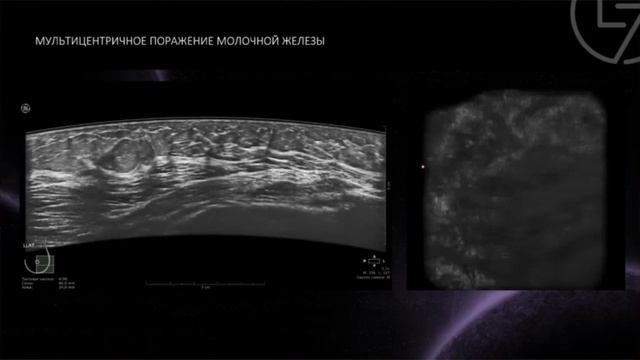Объемный ультразвук ABUS и его возможности в грейдировании РМЖ - Тамаева Фатима Арслановна