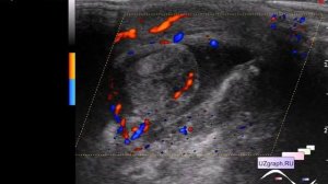 УЗИ мошонки - Орхоэпидидимит на фоне перекрута гидатиды