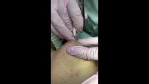 Электроэпиляция. Работа на Apilus