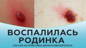 Воспалилась родинка. Случай из практики дерматовенеролога.