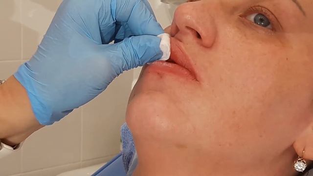 Меди-Лайт: Коррекция губ филлером при трещинах, заломах на губах смотреть онлайн