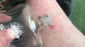 Гнойники и потники уничтожены! Обработка кожи ног и лица.