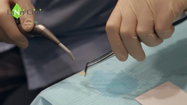 Протезирование зубов в Москве - стоматология Lanri Clinic