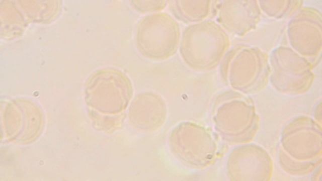 Эритроциты крови превращаются в эхиноциты (Таймлапс) смотреть онлайн