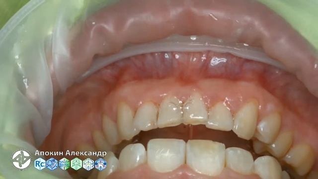 Professional oral hygiene - case 002 Acteon, DTE, Dentsply Sirona, Coxo, 3M, KerrHawe (livestream)
