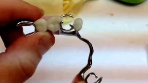 Бюгельный протез на нижнюю челюсть